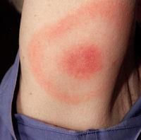 Foto 3: Una exantema con forma de 'blanco de un objetivo' Foto 3: Una exantema con forma de 'blanco de un objetivo'