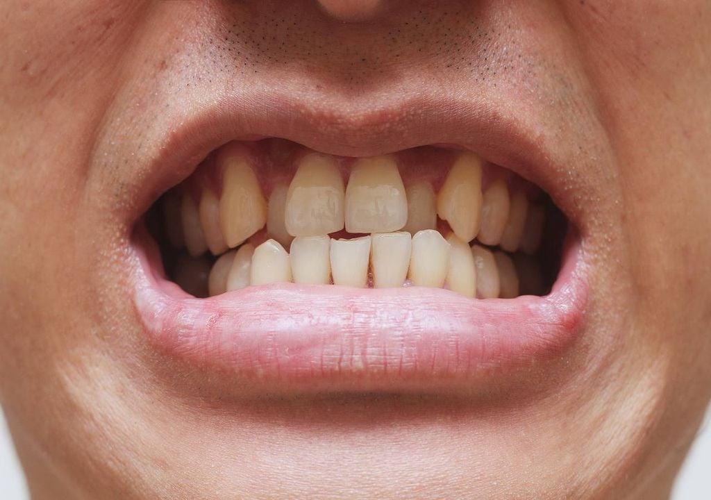 Desalinhamento dos dentes Desalinhamento dos dentes