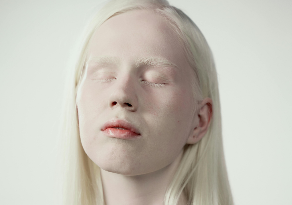 Albino-Person