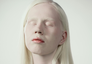 Albinismus: viel mehr als ein Mangel an Pigmentierung!