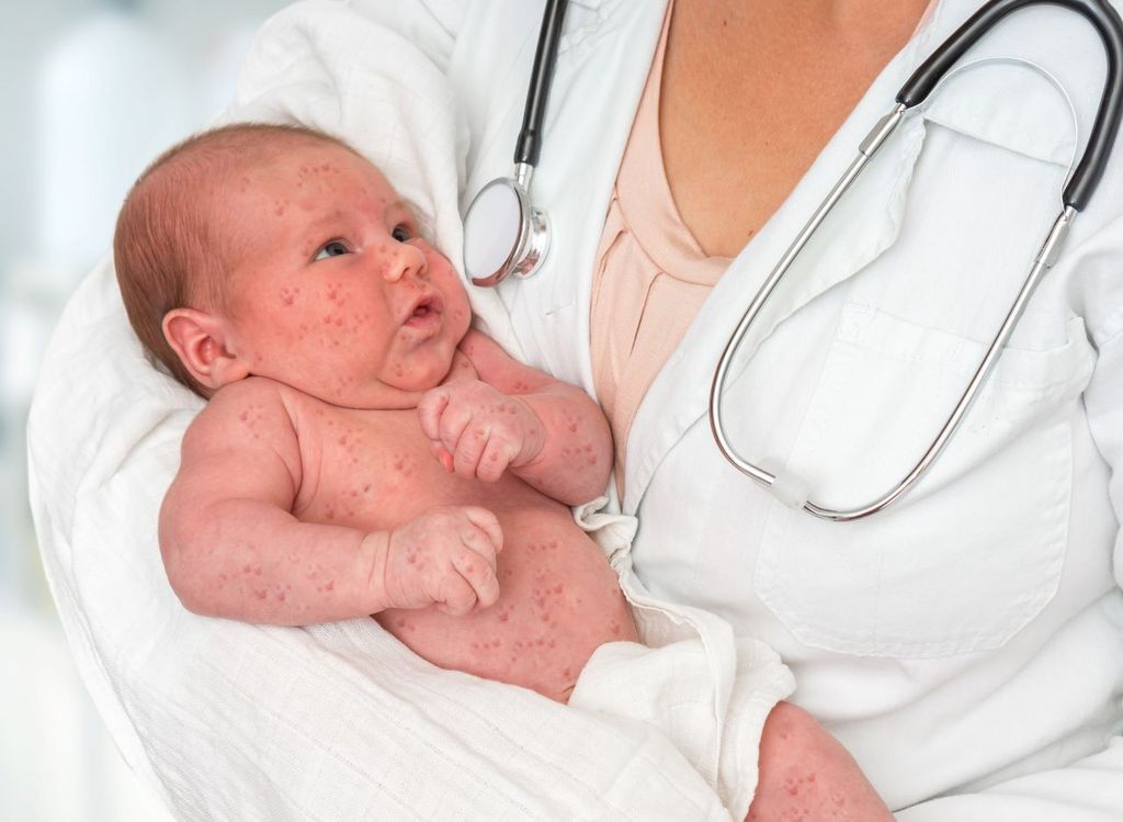 Los más afectados por el sarampión son los bebés de 0 a 4 años de edad. Los más afectados por el sarampión son los bebés de 0 a 4 años de edad.