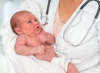 Brotes de sarampión en México: qué sabemos y cómo protegernos de la enfermedad