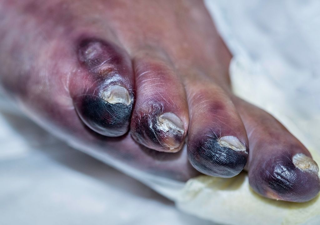 congelacion, tejido muerto