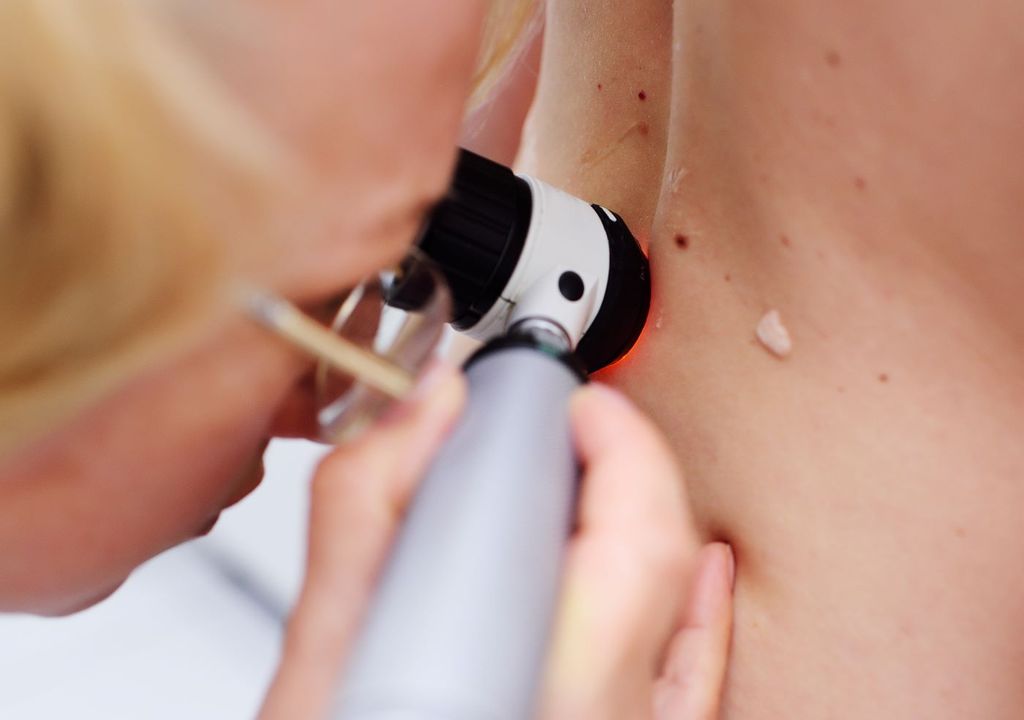 La Asociación Americana del Cáncer advierte que el factor genético también está presente en la aparición del cáncer de piel. La Asociación Americana del Cáncer advierte que el factor genético también está presente en la aparición del cáncer de piel.