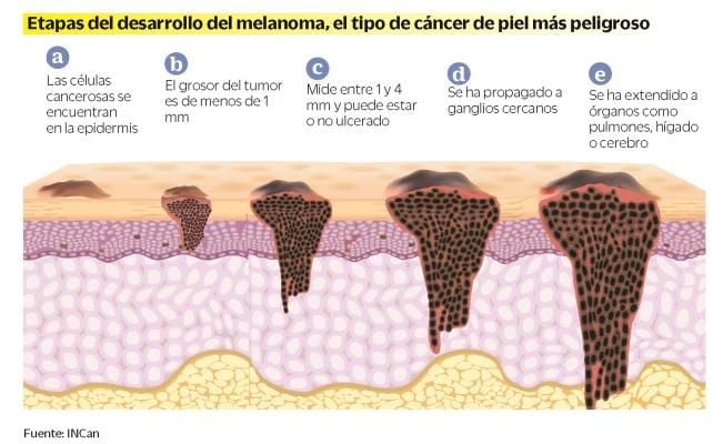 Меланома толщина по бреслоу. Уровни меланомы кожи по Кларку. Четвертый уровень инвазии меланомы по Кларку. Степень меланомы по Кларку. Меланома 5 стадия по Кларку.