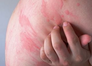 Cette femme est allergique à l'eau ! Elle ne peut pas boire, pleurer ou suer : comment vit-elle ?