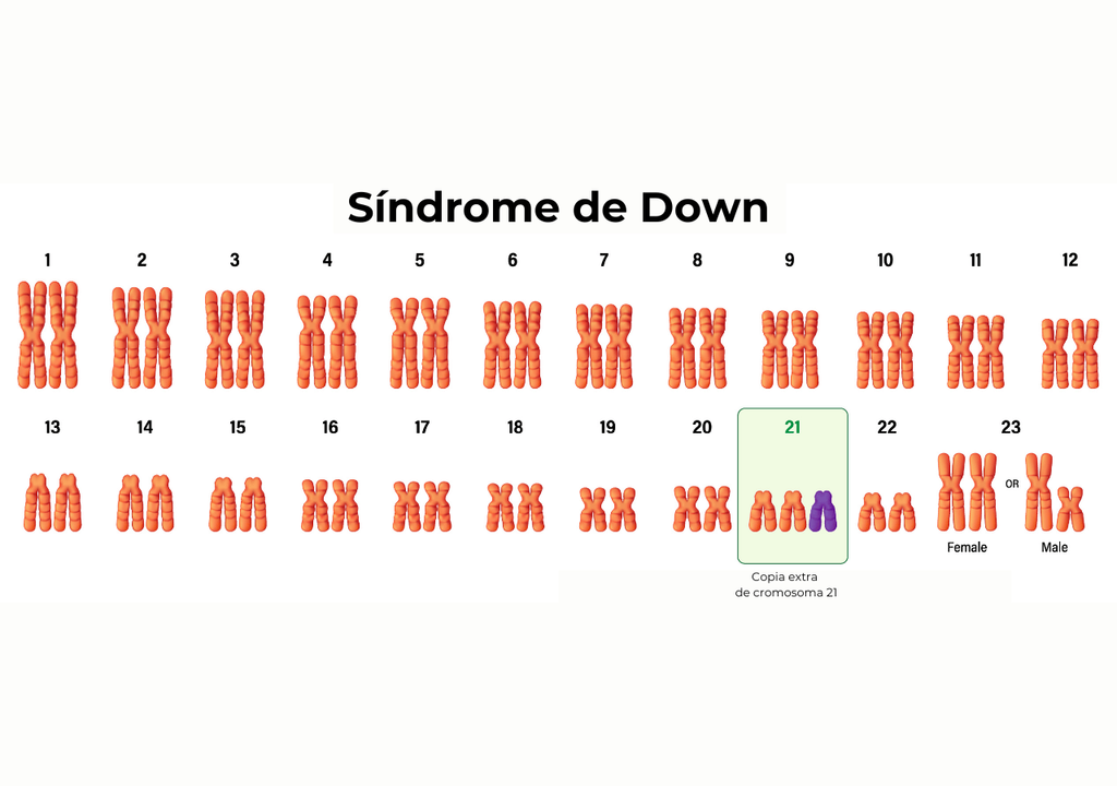 El síndrome de Down es un trastorno genético originado por una división celular anormal que produce una copia adicional total o parcial del cromosoma 21. El síndrome de Down es un trastorno genético originado por una división celular anormal que produce una copia adicional total o parcial del cromosoma 21.