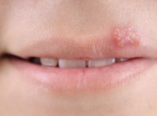 Con la llegada del verano, también comienzan los brotes de herpes labial, son de las primeras causas de consulta