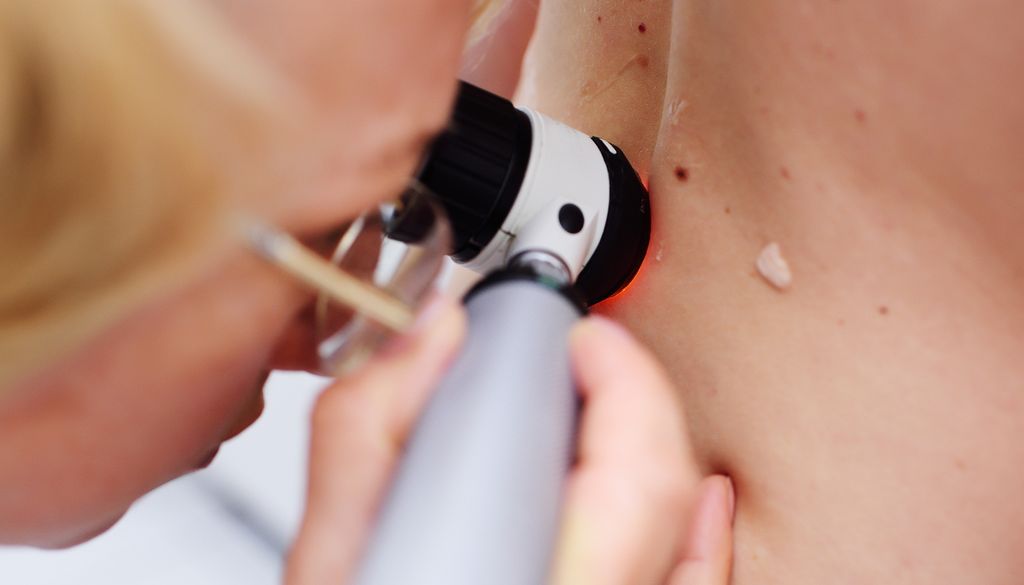 El uso de protección solar es crucial para prevenir el cáncer de piel o melanoma.