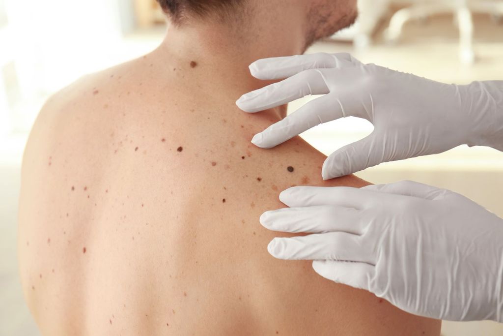 A timely check-up is the key to preventing skin cancer
