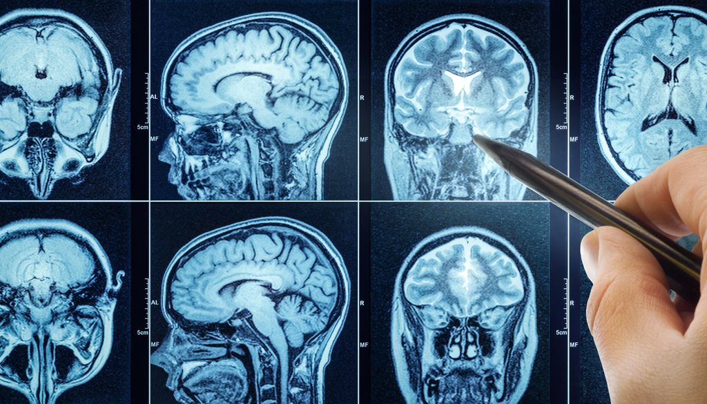 El efecto placebo es una respuesta neurobiológica real que refleja la extraordinaria conexión entre pensamiento y cuerpo.
