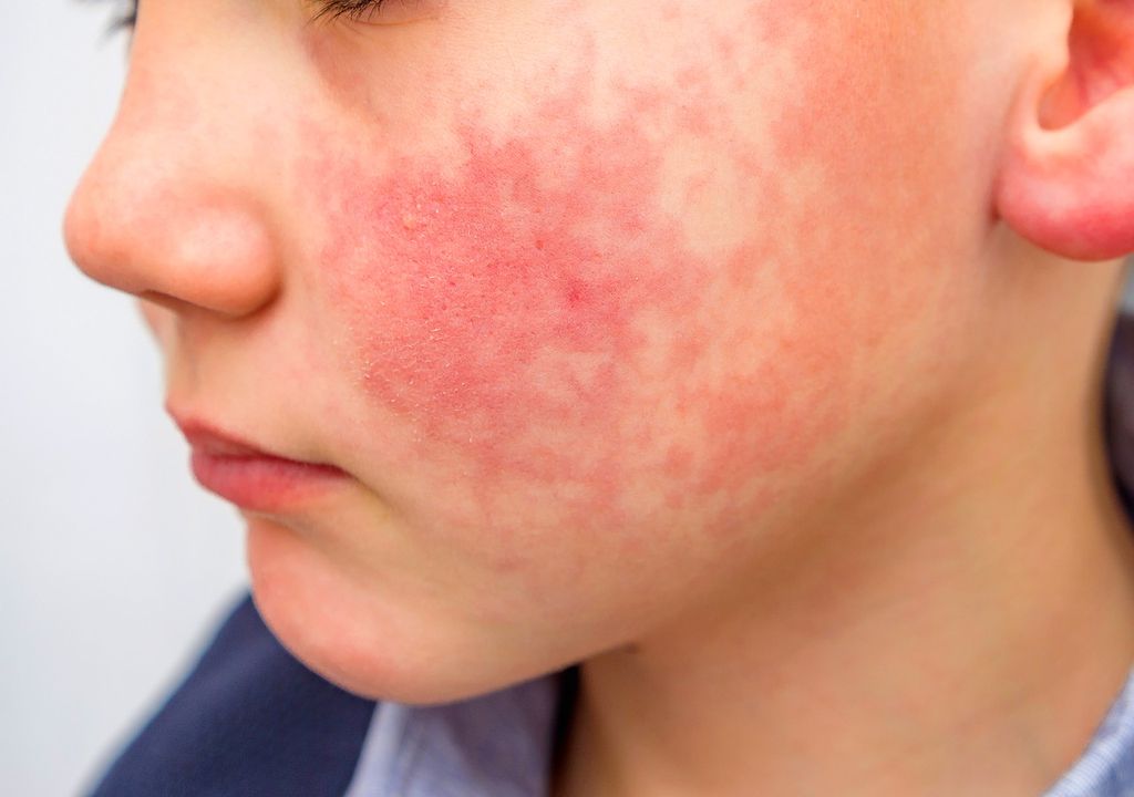 Il existe une maladie virale très contagieuse, généralement courante chez les enfants, qui se manifeste par une éruption cutanée et est communément connue sous le nom de maladie de la "joue giflée".