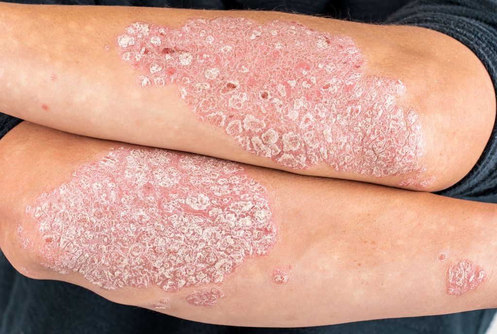 La psoriasis no es contagiosa, es una enfermedad autoinmune