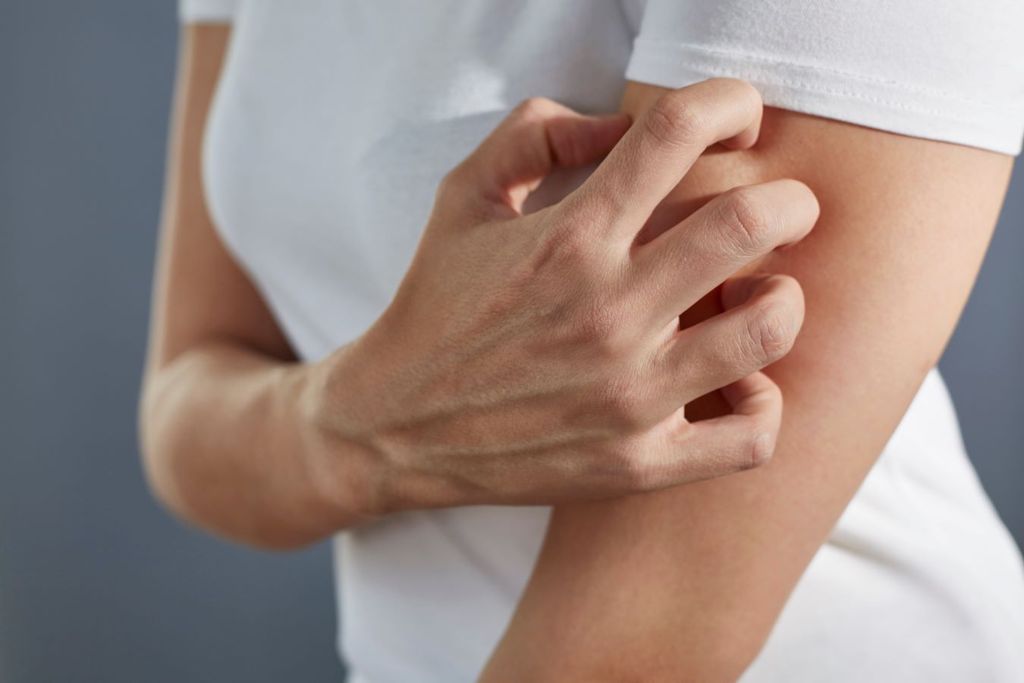 La urticaria o comezón es una de las afecciones más comunes por el frío.