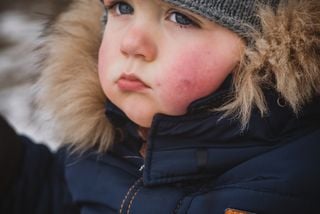 Alergias durante el frío: cuáles son los síntomas y cómo se diagnostica 