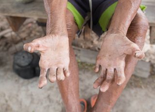 Hanseníase não é uma doença do passado: Brasil fica atrás somente da Índia em número de casos!