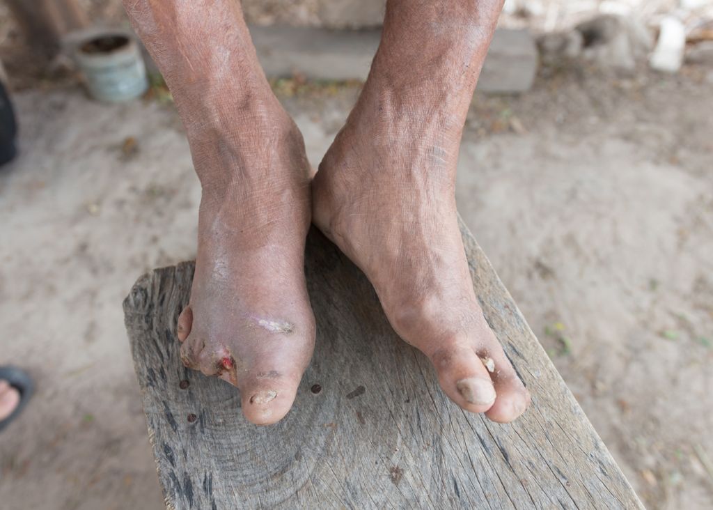 Hanseníase lesões Brasil