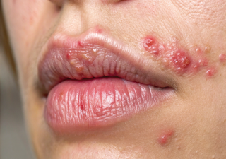 Herpes kann das Gehirn schädigen: Neue Studie zeigt, wie das Virus Verhalten verändert