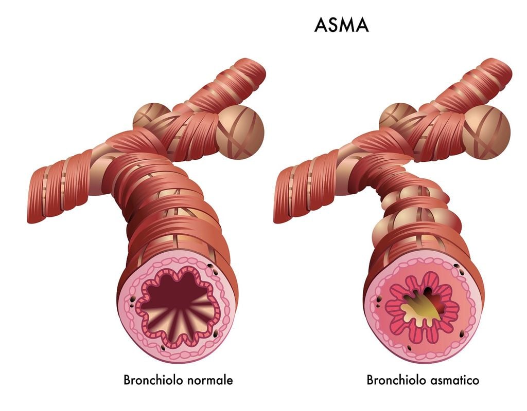 Bronquio normal y contraído por el asma
