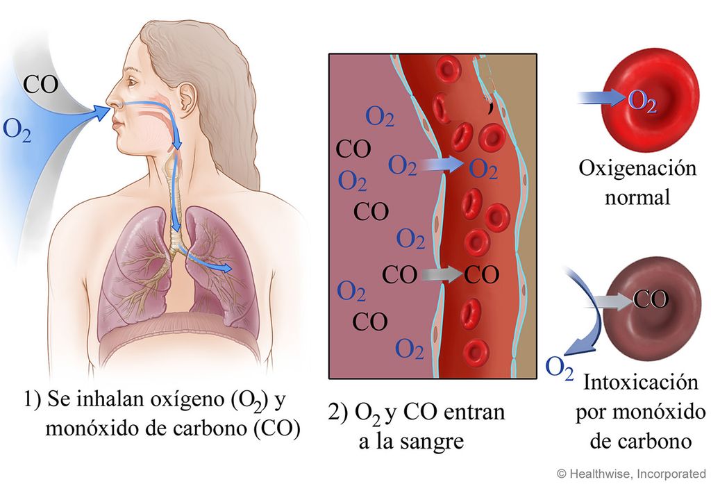 intoxicación con monóxido de carbono gas pulmón estufa intoxicación con monóxido de carbono gas pulmón estufa