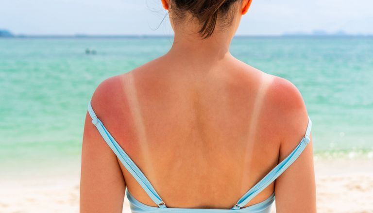 KI erkennt Risikomuster f&uuml;r Hautkrebs besonders fr&uuml;h