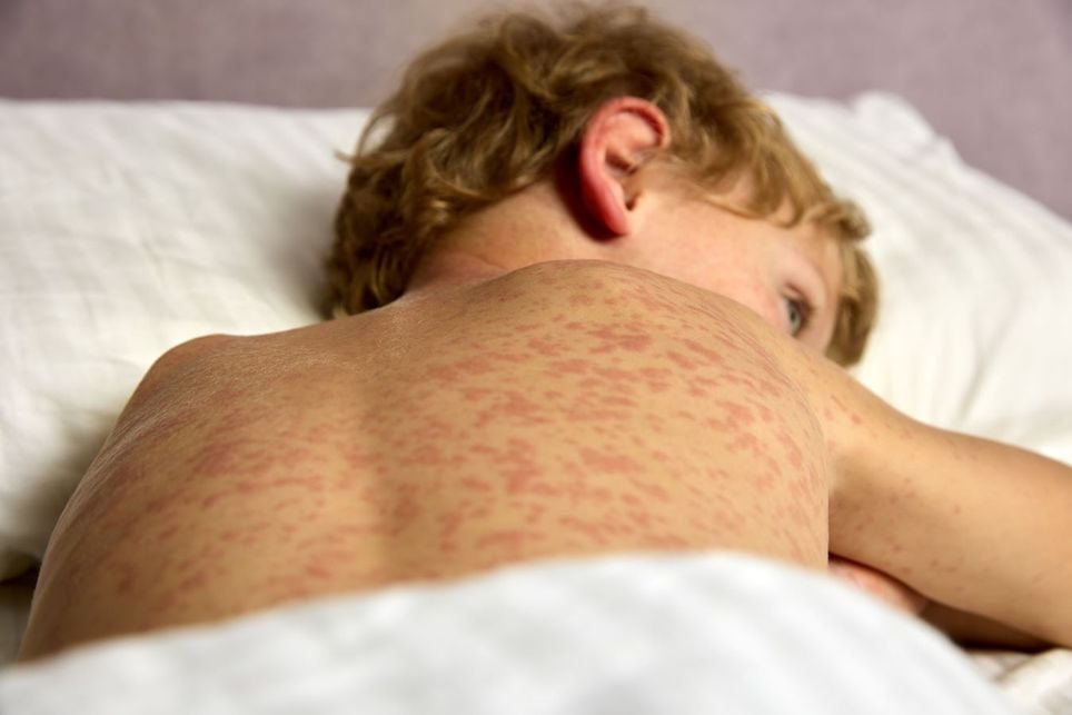 Measles is very contagious, a patient can affect up to 9 out of 10 people around him