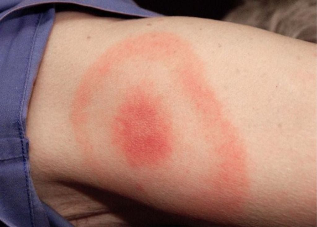 Erupcion Lyme