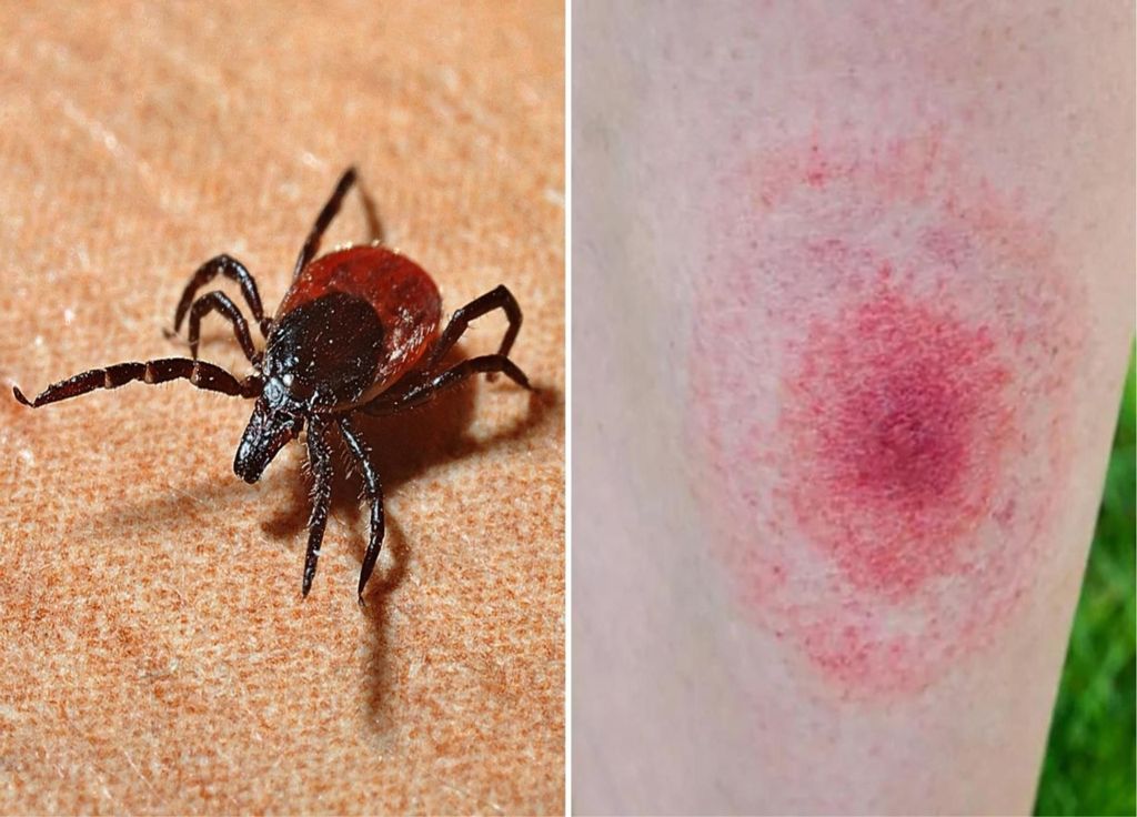 Enfermedad Lyme Argentina