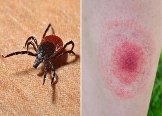 La amenaza silenciosa de Lyme, la enfermedad de los famosos: ¿por qué es tan difícil de detectar?
