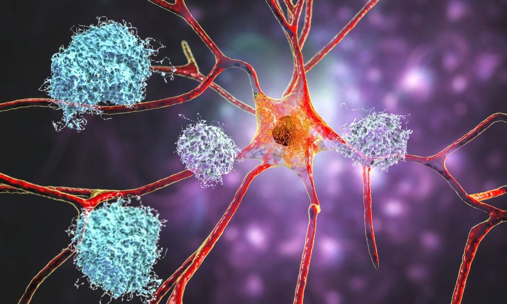 La estimulación cerebral profunda podría mejorar la calidad de vida de algunas personas y puede reducir el temblor, la rigidez, la lentitud y los movimientos involuntarios.