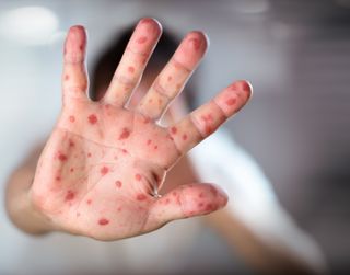 ¿Debería recibir una dosis de refuerzo contra el sarampión? Esto es lo que dice la ciencia 