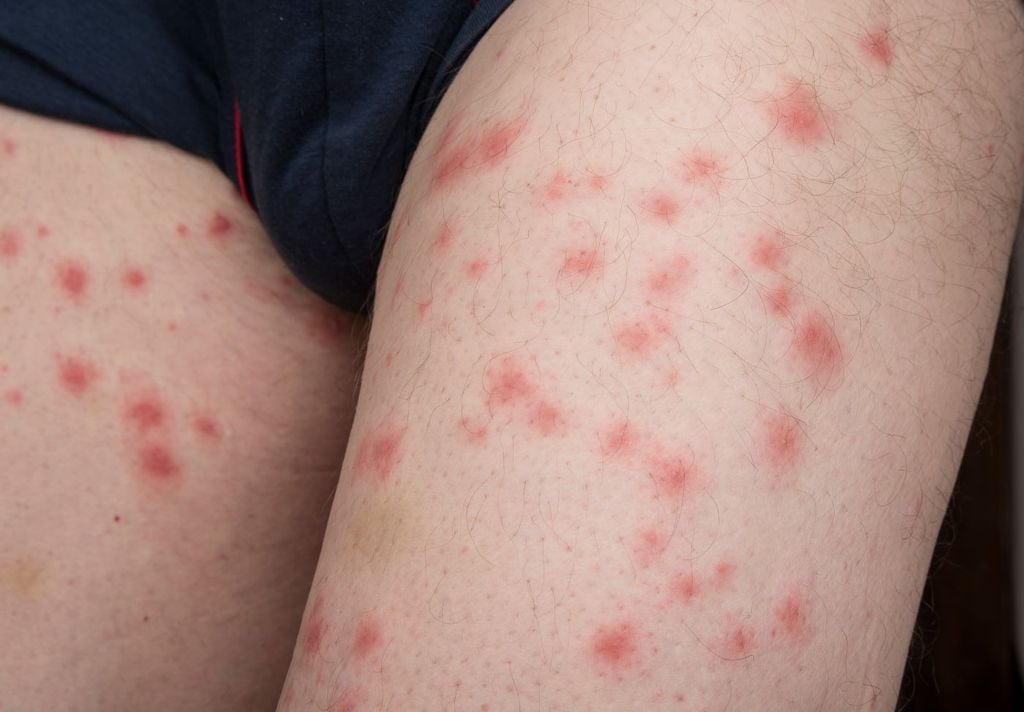 Las chinches provocan comezón intensa, inflamación y lesiones que pueden verse como manchas rojizas o púrpuras. Las chinches provocan comezón intensa, inflamación y lesiones que pueden verse como manchas rojizas o púrpuras.
