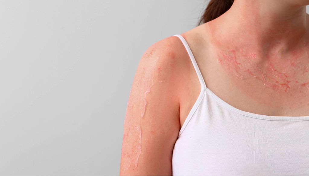 dermatitis El calor debilita la barrera de la piel favoreciendo los picores e irritaciones