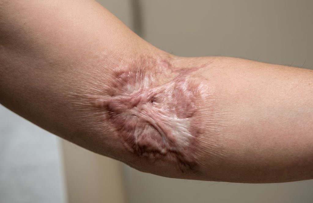 ¿Por qué los humanos formamos cicatrices tras una herida mientras que las salamandras reconstruyen extremidades completas sin enfermar de cáncer? ¿Por qué los humanos formamos cicatrices tras una herida mientras que las salamandras reconstruyen extremidades completas sin enfermar de cáncer?