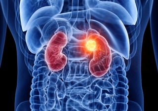 Lo que debes saber sobre los alimentos que dañan tus riñones sin darte cuenta