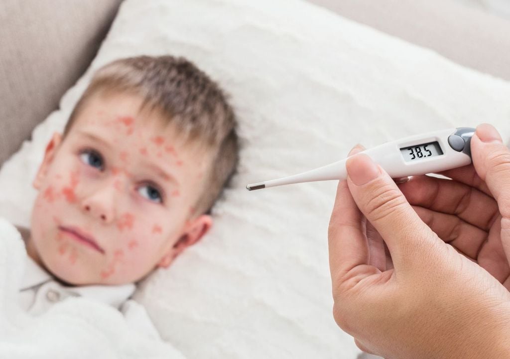 Niño infectado con virus del sarampión