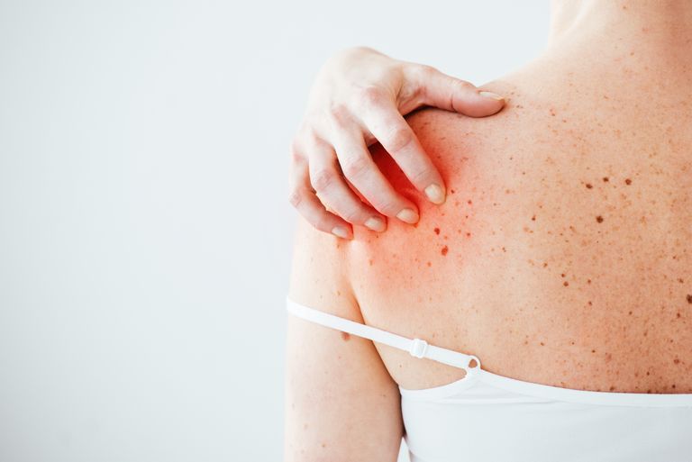 Melanoma y sol, enemigos íntimos. Qué es y cómo lo puedes prevenir Melanoma y sol, enemigos íntimos. Qué es y cómo lo puedes prevenir