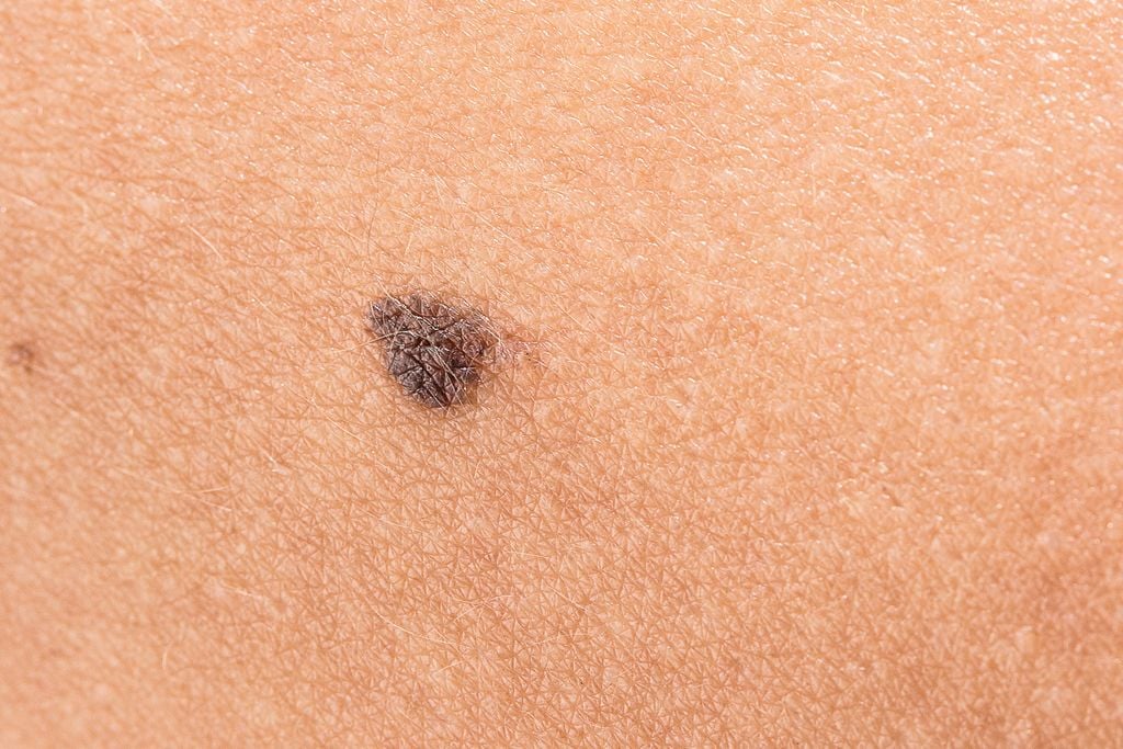 Melanoma Y Sol Enemigos íntimos Qué Es Y Cómo Lo Puedes Prevenir 8349