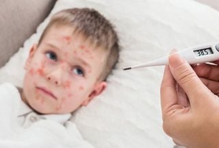 M&eacute;xico en alerta: brote activo de sarampi&oacute;n con cientos de casos, ni&ntilde;os de 1 a 4 a&ntilde;os los m&aacute;s vulnerables