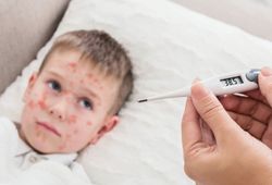 Nueva alerta epidemiológica en México por otro caso de sarampión: ya suman siete afectados y ninguno estaba vacunado