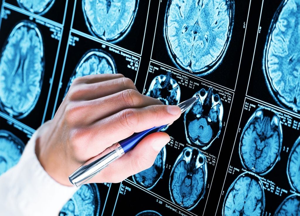 Maladie d'Alzheimer prétexte cerveau
