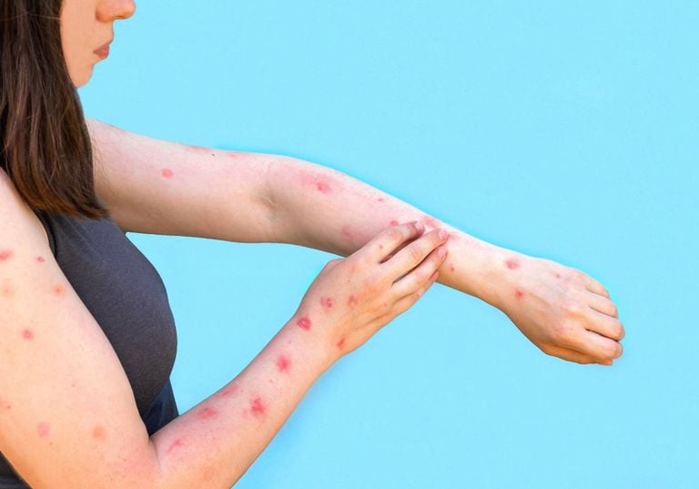 Mpox: novo estado confirma infec&ccedil;&atilde;o e Brasil passa dos 80 casos; saiba cen&aacute;rio atual da doen&ccedil;a no pa&iacute;s