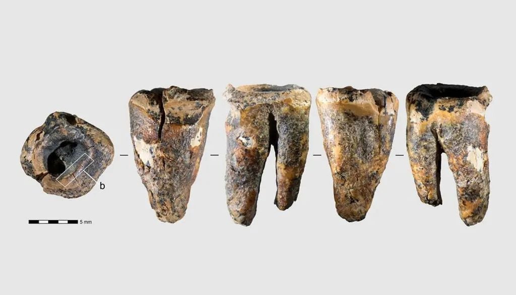 Fóssil de dente neandertal sugere que procedimentos odontológicos começaram milhares de anos antes do que se imaginava. Crédito: (Zubova AV, Zotkina LV, et al./Divulgação) Fóssil de dente neandertal sugere que procedimentos odontológicos começaram milhares de anos antes do que se imaginava. Crédito: (Zubova AV, Zotkina LV, et al./Divulgação)