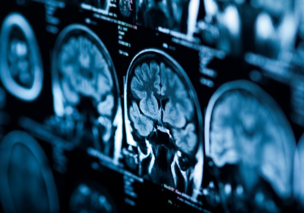 La mayoría de los desplazamientos y deformaciones tendieron a revertirse gradualmente en los seis meses posteriores al regreso a la Tierra.