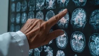 Cient&iacute;ficos de la Keck School identifican tres tipos de progresi&oacute;n diferentes del Alzheimer