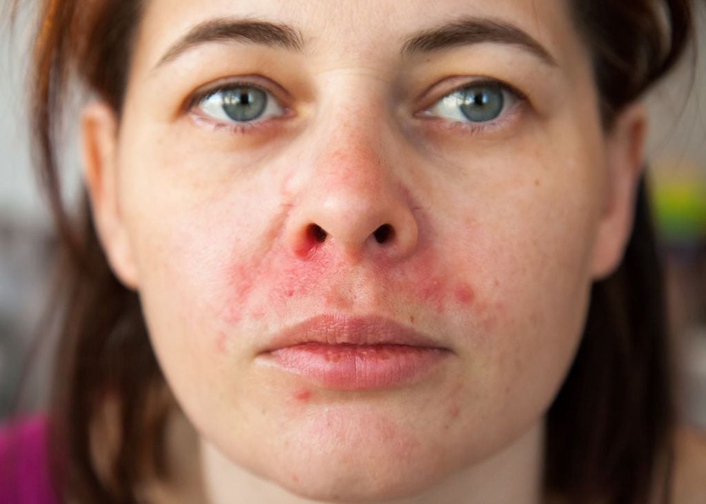 En México el Lupus Eritematoso Sistémico es la segunda causa más frecuente de consulta en reumatología En México el Lupus Eritematoso Sistémico es la segunda causa más frecuente de consulta en reumatología