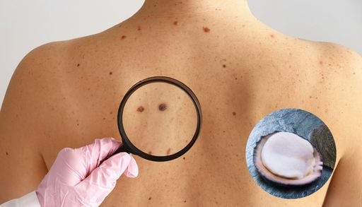 &iquest;Qu&eacute; hace el "loco" en una vacuna contra el c&aacute;ncer? El avance chileno que busca combatir el melanoma