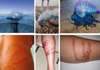 ¿Qué hacer si te pica una fragata portuguesa?