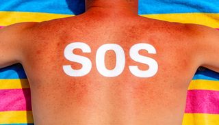 Rayons UV : voici en combien de minutes votre peau peut attraper un coup de soleil cet &eacute;t&eacute; en France