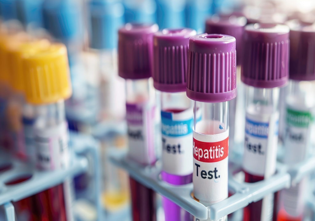 Bluttests, Hepatitis, Ausbreitung Bluttests, Hepatitis, Ausbreitung
